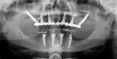 Simultaneous Le Fort I Osteotomy And Zygomatic Implant Placement Zygo Pro