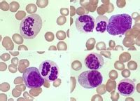 Leucemia Mieloide Cr Nica At Pica Bcr Abl Negativo