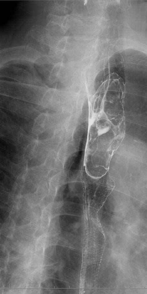 Endoscopic Resection Of A Giant Fibrovascular Esophageal Polyp By Use