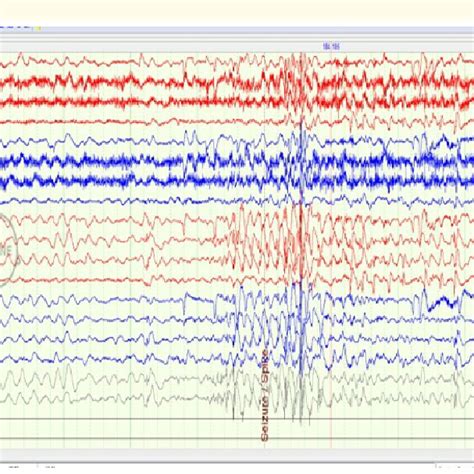 Eeg Of The Patient Showing Epileptiform Discharges Localized To The