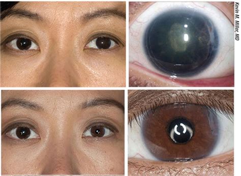 The Artificial Iris In Practice