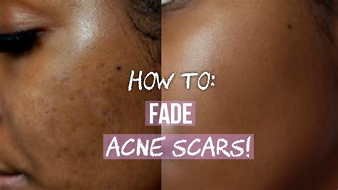 How To Get Rid Of Acne Scars On Face And Body Youtube