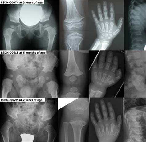 Radiographic Findings In COMP Negative Patients Referred As PSACH