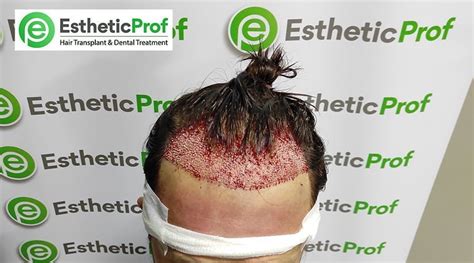 Hair Transplant Without Shaving Estheticprof