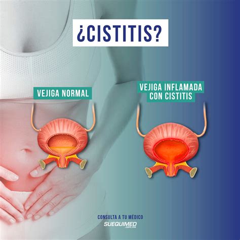 Suequimed - La cistitis es una inflamación de la vejiga.... | Facebook