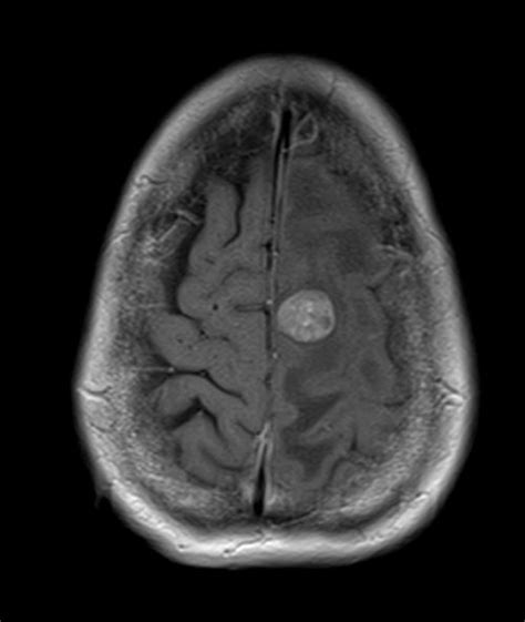 Mri T Post Contrast Gadolinium Sequence Physics And Image Appearance