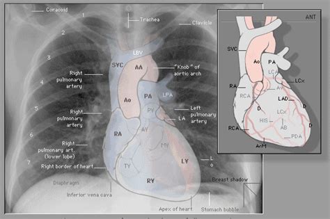 Labeled Chest X Ray Cxr Radiology Schools Radiology Student