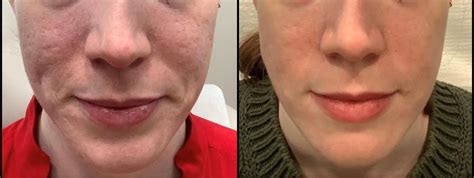 Genius Rf Microneedling Before After Photo Gallery Washington Dc