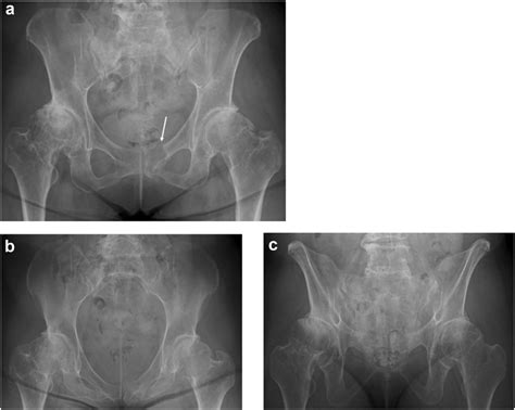 A Anteroposterior B Inlet And C Outlet Pelvic Radiograph Taken