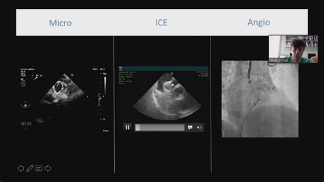 Ecograf A Intracardiaca Qu Razones Hay Para Usarla Youtube