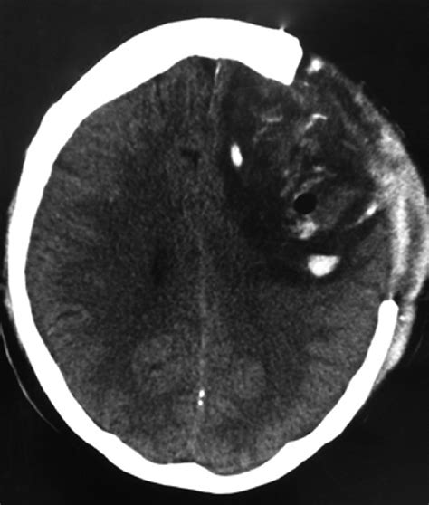 Ct Brain Postdecompressive Craniectomy And Evacuation Of The Frontal