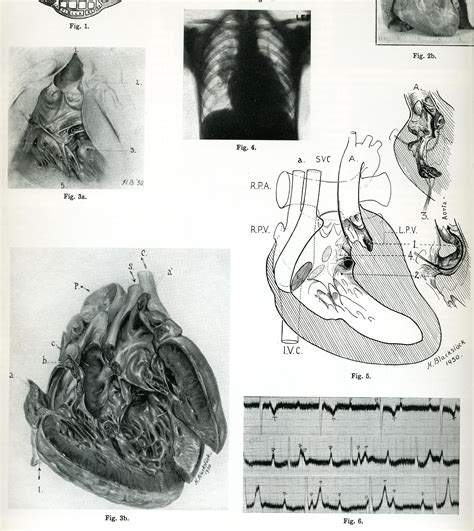 58 Double Inlet Left Ventricle Maude Abbott Medical Museum Mcgill