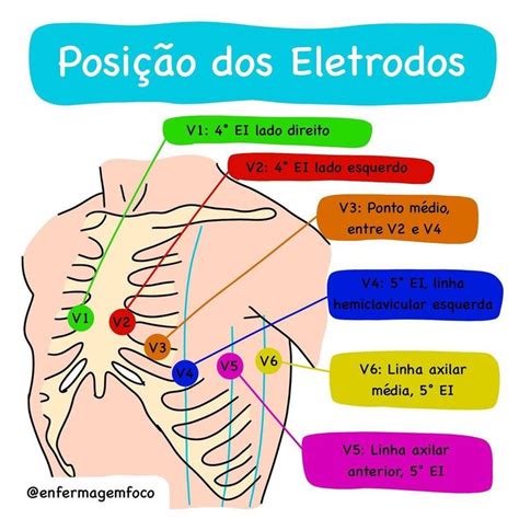 Enfermagem Em Foco On Instagram J A Posi O Correta Dos Eletrodos