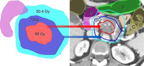 Simultaneous Integrated Boost Sib And Simultaneous Integrated Download Scientific Diagram