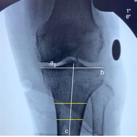 The Line Length A From The Distal Femoral Condyle Parallel To The