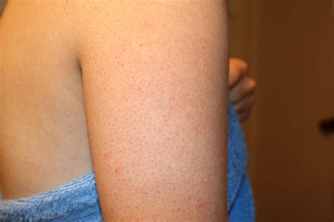 What Is Chicken Skin Keratosis Pilaris Kp And Natural Treatments