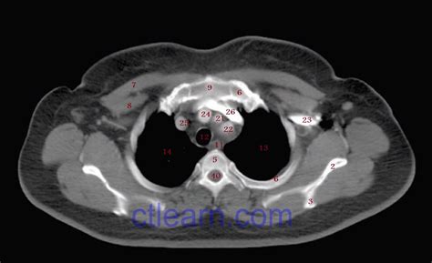 Anatomy Ct Axial Chest