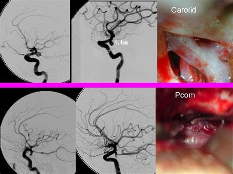 True Pcom Artery Aneurysm s Allan Taylor David Le