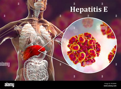 Hepatitis E Infection Computer Illustration Showing The Liver And A