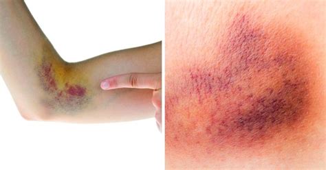 Dicas simples para eliminar os hematomas mais rápido Como quitar