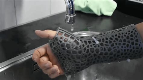 3d Printed Orthopedic Casts Offer Custom Thermal Comfort Design All3dp