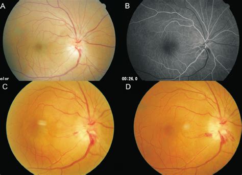 A The Disc Swelling And Flame Shaped Disc Hemorrhage Were Noted B