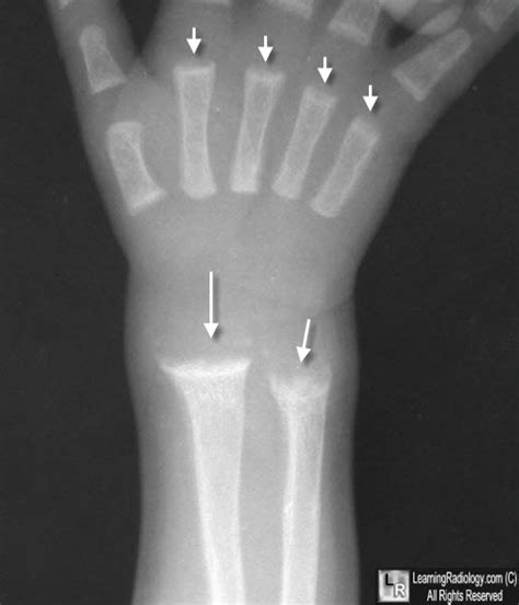 Learningradiology Rickets Osteomalacia