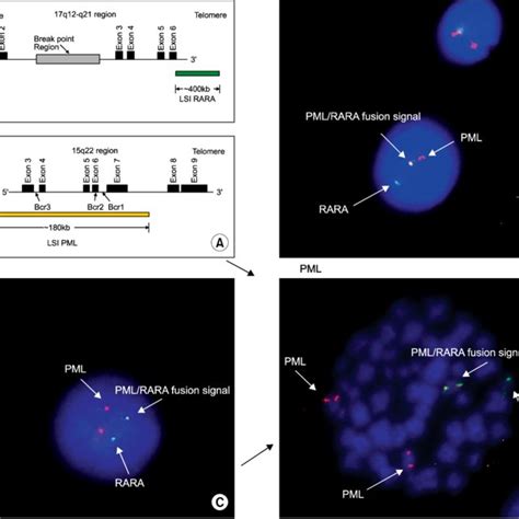 A Metaphase Spread With The Cytocell PML RARA Extra Signal Probe