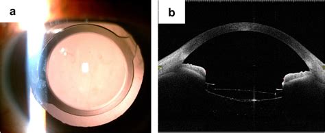 IOL Image Of The Patients Left Eye On The Seventh Postoperative Day A