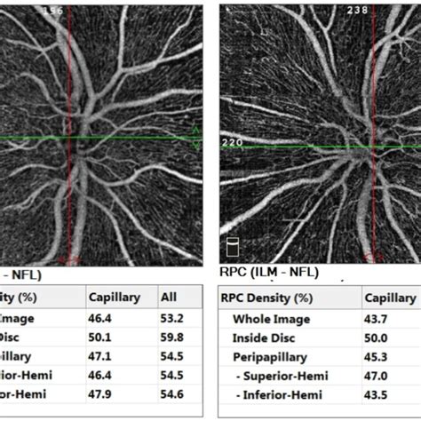 Optical Coherence Tomography Angiography Octa Of Optic Nerve Head And