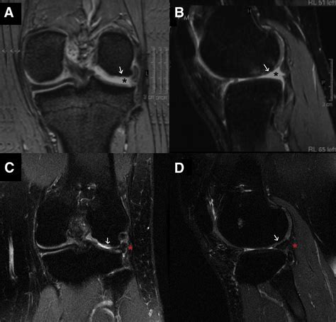 Meniscal Allograft Transplantation Is An Effective Treatment In Patients Older Than 50 Years But