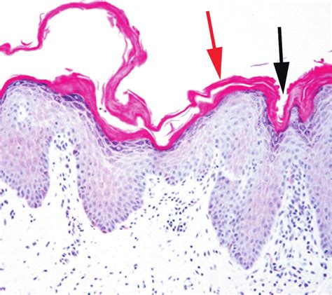 Skin Biopsy Specimen From Lateral Thorax Compact Orthokeratotic