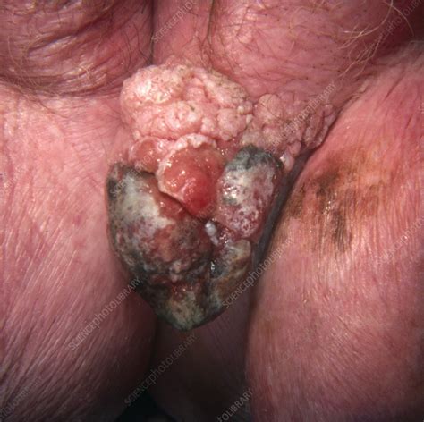 Vulvar Squamous Cell Carcinoma