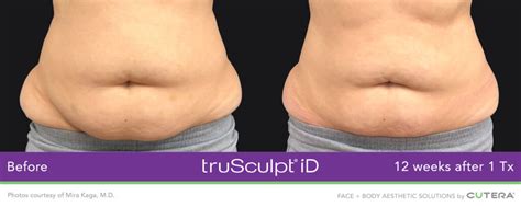 Trusculpt Id Before And Afters