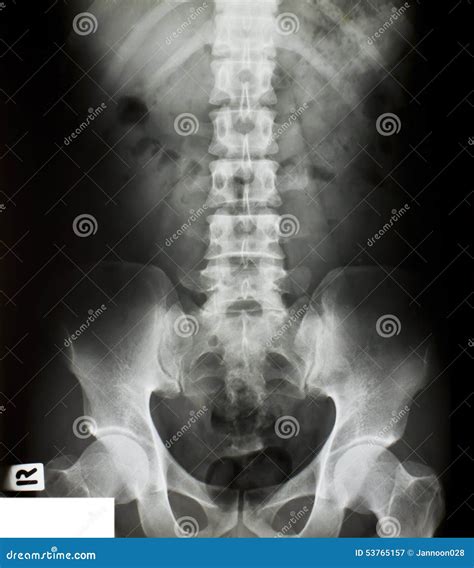 X Ray Of The Pelvis Stock Image Image Of Anatomy Closeup 53765157