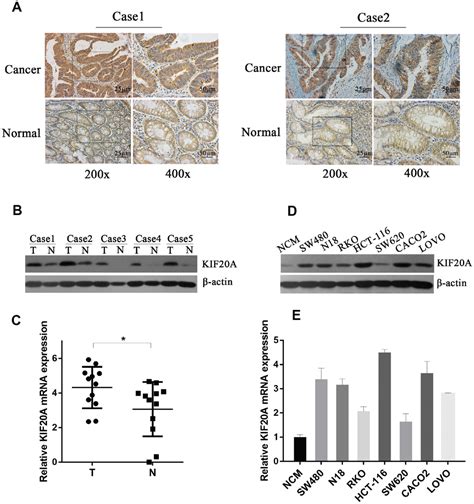 Kif A Promotes Cellular Malignant Behavior And Enhances Resistance To