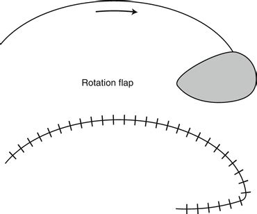 Rotation Flaps Of The Scalp Study Of The Design Planning And