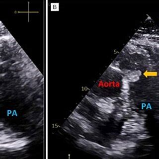 Transthoracic Echocardiogram Parasternal Short Axis View Of The Great