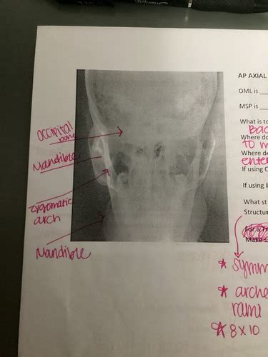 AP Axial Townes Method For Zygomatic Arch Flashcards Quizlet