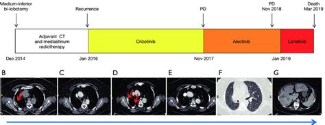 Timeline Duration And Computed Tomography Scan Evaluation Of Each Download Scientific Diagram