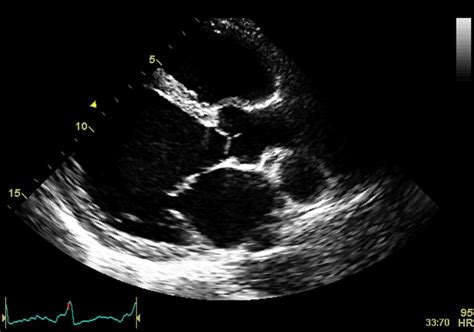 Echocardiographic Aspect Of DCM Parasternal Longaxis View Showing A