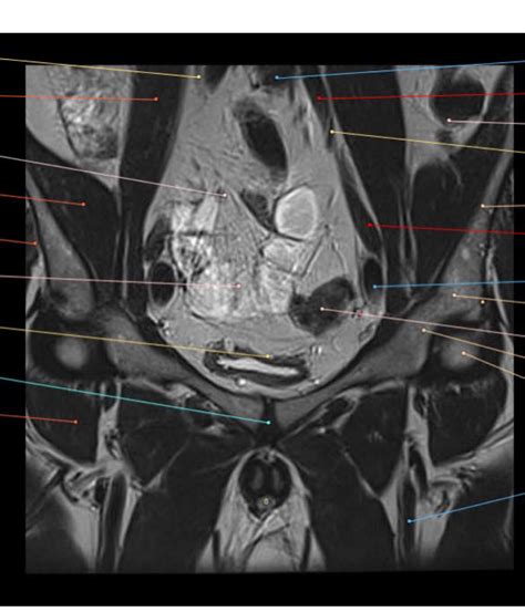 Diagram Of Male Pelvis Coronal Mri 3 Quizlet