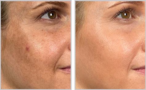 Halo Laser Skin Resurfacing Consultation With Doctor 58 Off