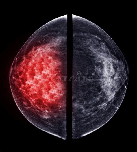 X Ray Digital Mammogram Or Mammography Of Both Side Breast Standard