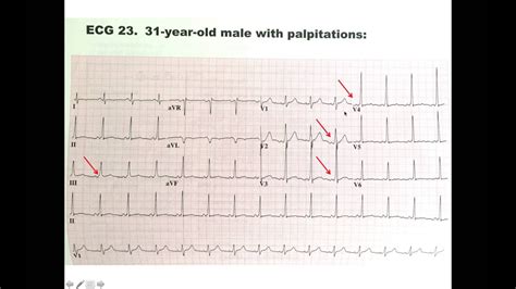 Wpw Dr Ben Zur Electrocardiogram Ecg Ekg Youtube