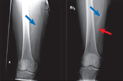 Ap X Rays Show Previous Vascular Calcifications Left Blue Arrow With