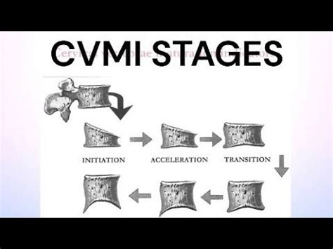 Cervical Vertebrae Maturation Indicators Short Note On CVMI YouTube