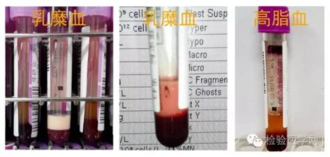 专业文章乳糜血与脂血在血常规检测上不同影响分析 北京九强生物技术股份有限公司