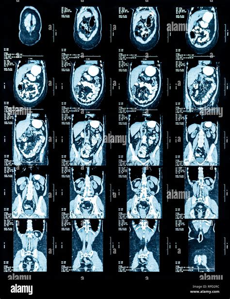 Tomografia A Risonanza Magnetica Immagini E Fotografie Stock Ad Alta