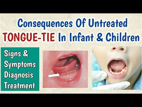 Tongue-tie In Infants & Children | Ankyloglossia Signs & Symptoms, Diagnosis and Treatment - YouTube